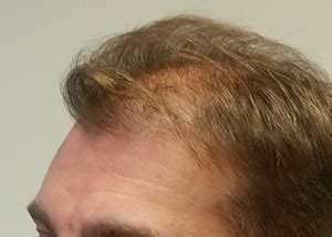 surgical hair restoration st louis mo